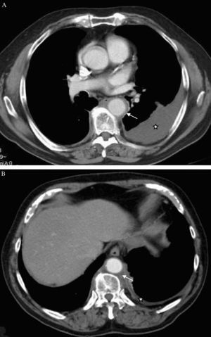 Quilotórax en paciente con fibrosis mediastínica. Tomografía computarizada toracoabdominal (A y B): derrame pleural izquierdo (estrellas) y aorta descendente rodeada por una capa de 3mm de espesor compatible con fibrosis periaórtica (flechas).