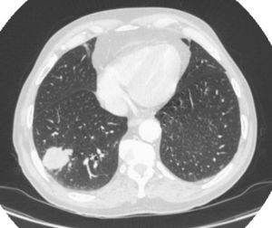 Tomografía computarizada preoperatoria, donde se observa un nódulo pulmonar de 3,8cm de diámetro y densidad heterogénea en el lóbulo inferior derecho, el cual entra en contacto con la pleura.