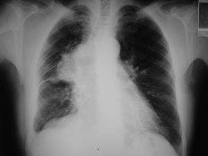 Gran masa en el hilio derecho que produce pérdida de volumen del pulmón derecho.