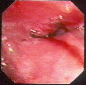 Estenosis del bronquio del lóbulo superior derecho por infiltración tumoral de la mucosa.