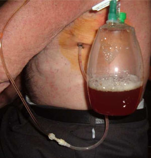 Detalle de la colocación del drenaje pleural durante el vaciado del líquido pleural en el domicilio del paciente.