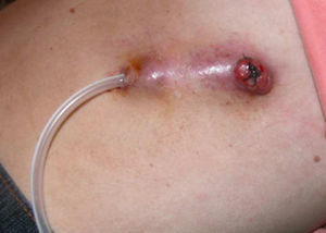 Diseminación de un adenocarcinoma a través del canal de inserción del drenaje pleural tunelizado. Se aprecia un nódulo subcutáneo en el lugar de entrada del catéter en la piel, y otro de mayor tamaño en el lugar de entrada del catéter a la cavidad pleural.