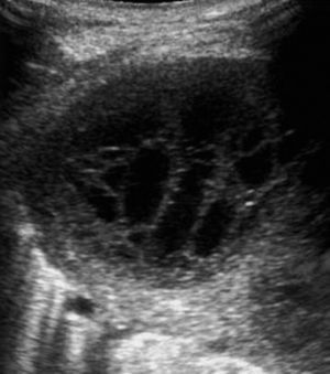 Derrame pleural con marcado engrosamiento de hojas pleurales y septos gruesos en su interior. El estudio bioquímico del líquido confirmó la sospecha de exudado.