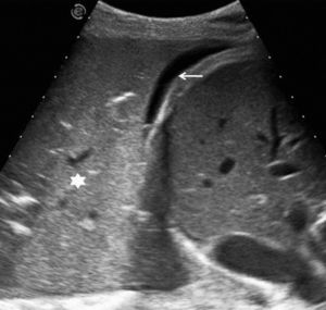 Ecografía realizada a un paciente ingresado en una unidad de cuidados intensivos, con radiografía de tórax de difícil interpretación. Se observan una voluminosa consolidación pulmonar (asterisco) y un mínimo derrame pleural subpulmonar (flecha).