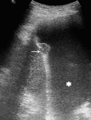 Derrame pleural con múltiples ecos internos (asterisco) y un nódulo sólido en la pleura diafragmática (flecha). La citología del líquido pleural fue diagnóstica de metástasis.