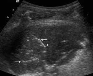 Consolidación de espacio aéreo ecogénica con imágenes lineales hiperecogénicas ramificadas (flechas), correspondientes a broncograma aéreo en paciente con neumonía bacteriana.