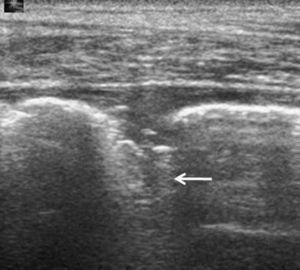 Lesión periférica pulmonar, indicativa de infarto pulmonar, con imagen lineal en el vértice (flecha) correspondiente al vaso aferente trombosado.