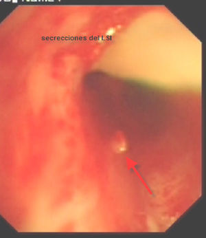Lesión tumoral residual en la pared del bronquio del lóbulo superior izquierdo después de la resección. Se observan segmentos del lóbulo superior izquierdo permeables y que drenan las secreciones retenidas.