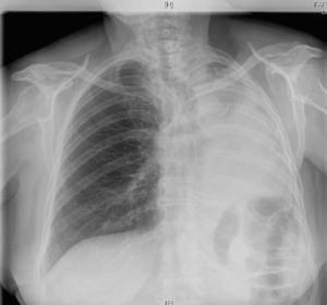 Atelectasia pulmonar completa, secundaria a crecimiento endobronquial de metástasis.