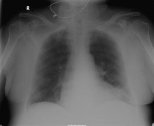 Radiografía posteroanterior de tórax que muestra signos de hipertensión pulmonar precapilar y aumento de la trama broncovascular bilateral.