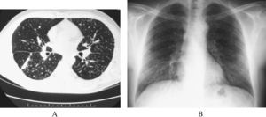 A: tomografía computarizada de alta resolución del caso 1, donde se observan nódulos parenquimatosos de predominio en segmentos posteriores, con formación de fibrosis masiva progresiva y nodulación subpleural. B: radiografía posteroanterior de tórax del caso 3: tamaño p-q, profusión 1/2 (clasificación de la Organización Internacional del Trabajo 2000).