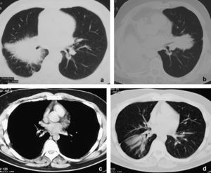 Caso 1: tomografía computarizada de tórax (a) con contraste que muestra una masa espiculada de gran tamaño alrededor del bronquio intermediario; 9 meses después (b) se detecta una masa espiculada contralateral que entra en contacto con el bronquio de la língula. El paciente fue tratado con prednisona. Caso 2: la tomografía computarizada torácica (c) muestra una lesión endobronquial con calcificaciones puntiformes en el bronquio lobular inferior (flecha), que produce una atelectasia parcial postobstructiva del lóbulo inferior derecho (d).