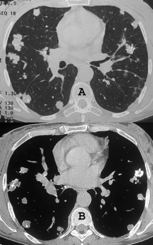 Tomografías computarizadas de alta resolución de los lóbulos inferiores, con vistas del pulmón (A) y mediastino (B), que muestran nódulos pulmonares múltiples de tamaños variables y bordes irregulares, y algunos con calcificación.