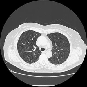 Tomografía computarizada que evidencia múltiples imágenes quísticas en todo el campo pulmonar de ambos hemitórax.