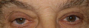 Síndrome de Horner traumático en el ojo derecho.