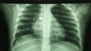 Radiografía de tórax donde se observa una imagen compatible con la correspondiente a una pila de botón que ha impactado en el bronquio principal derecho.