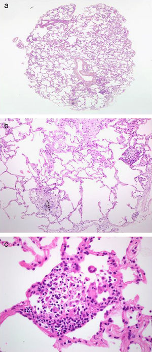 a) Imagen de microscopia óptica (×2) sobre corte histológico de biopsia pulmonar obtenida mediante criosonda. Tinción hematoxilina-eosina. Obsérvese la presencia de numerosos espacios alveolares, así como estructuras bronquiales y alveolares. El paciente fue diagnosticado de una alveolitis alérgica extrínseca. b) Imagen microscópica a mayor aumento del mismo caso (×20). Obsérvese el grado de conservación de las estructuras alveolares, así como la presencia de infiltrados mononucleares intersticiales leves y granulomas no caseificantes. c) Imagen microscópica (×40) donde se identifica un granuloma no caseificante.