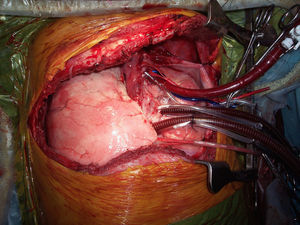 Cirugía finalizada donde se puede ver el nuevo órgano implantado, así como la canulación cardíaca (aórtica y bicava).