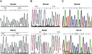 Secuencias parciales del gen BMPR2. En la parte superior, la secuencia normal y, en la inferior, la secuencia parcial del exón correspondiente mostrando la mutación. El círculo indica el cambio. A) Caso 7, exón 11 c.1472G>A, p.R491Q. B) Caso 2, exón 7 c.994C>T; p.R332X. C) Caso 17, exón 6 c.633C>T; p.R211X.