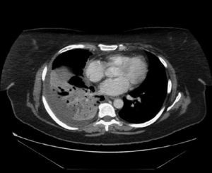 Tomografía computarizada de tórax que muestra consolidación parenquimatosa en el lóbulo inferior derecho y derrame pleural.
