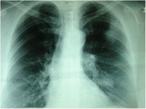 Radiografía posteroanterior de tórax. Se visualizan 3 lesiones nodulares sin broncograma aéreo, de 2–3cm de diámetro, localizadas en el hemitórax izquierdo; 2 adyacentes situadas en el lóbulo superior izquierdo, periféricas, y otra central y parahiliar en el lóbulo inferior del mismo lado.