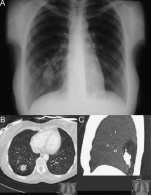 A) Radiografía de tórax (proyección posteroanterior): masa en el lóbulo inferior derecho. B) y C) TC torácica con contraste (corte axial y corte sagital): lesión polilobulada en segmento 10 derecho con radiolucencia segmentaria distal.