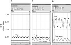 Registros representativos de flujo aéreo oral y concentración de oxígeno (O2) (sonda retronasal) en respiración tranquila. a) Respiración nasal (no existe recogida de señal de flujo), aire ambiente. b) Respiración bucal, aire ambiente. c) Respiración bucal, oxígeno a 4l/min. Las oscilaciones de los valores en la concentración de oxígeno se relacionan con el ciclo respiratorio, correspondiendo la FIO2 a los picos de la curva.