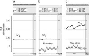 Registros representativos de flujo aéreo oral y concentración de oxígeno (O2) (sonda retronasal) en respiración de tipo jadeo: a) Respiración nasal (no existe recogida de señal de flujo), aire ambiente. b) Respiración bucal, aire ambiente. c) Respiración bucal, oxígeno a 4l/min. Se han agrandado los registros en relación a la magnitud tiempo para poder apreciar mejor el flujo a altas frecuencias ventilatorias.