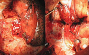Vista operatoria del lóbulo superior resecado y del bronquio traqueal verdadero.