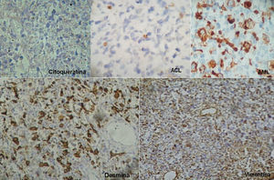 Inmunofenotipo concordante con un tumor de origen mesenquimático con línea celular muscular lisa (citoqueratina negativa, antígeno común leucocitario negativo en el componente celular proliferante y positivo en los linfocitos, actina de músculo liso positiva en el componente celular proliferante de distribución focal, desmina y vimentina intensamente positivas en el componente celular proliferante).