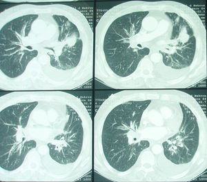 TC torácica (2008): masa de aproximadamente 3cm en LSI. Engrosamientos peribroncovasculares en hilio pulmonar ipsilateral. Adenopatías de tamaño significativo en mediastino e hilio pulmonar contralateral. Derrame pleural izquierdo con engrosamientos nodulares hipercaptantes en pleura de seno costofrénico izquierdo.