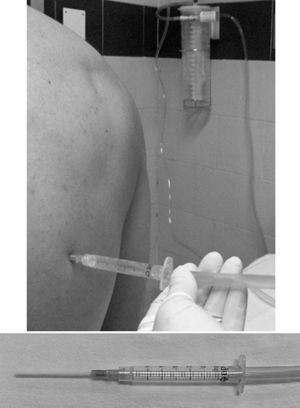 Arriba, procedimiento de toracocentesis terapéutica con ayuda de la succión de pared. Abajo, angio-CAT fenestrado en su tercio distal con un bisturí y conectado a la tubería de succión por medio de una jeringa de 3ml.