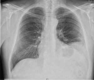 Radiografía de tórax posteroanterior. Se aprecia elevación del hemidiafragma izquierdo.