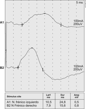 La velocidad de conducción demuestra una respuesta del nervio frénico izquierdo (A1) con latencia aumentada y amplitud disminuida. Respuesta normal del nervio frénico derecho (B2).
