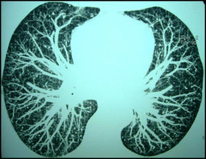 Patrón micronodular bilateral en una imagen de tomografía computarizada torácica con reconstrucción multiplanar (MIP).