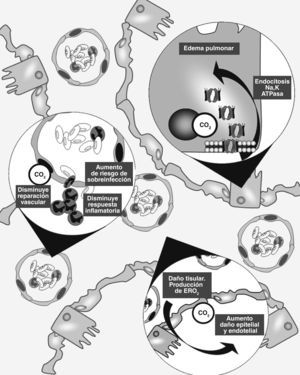 Esquema de los principales mecanismos de lesión pulmonar en los que el CO2 ha sido vinculado. 1) Endocitosis de la Na,K-ATPasa con disminución de la reabsorción de fluido alveolar. 2) Disminución de la respuesta inflamatoria con menor capacidad de reparación tisular y aumento del riesgo a sobre infecciones. 3) Aumento del daño tisular mediado por especies reactivas de O2.