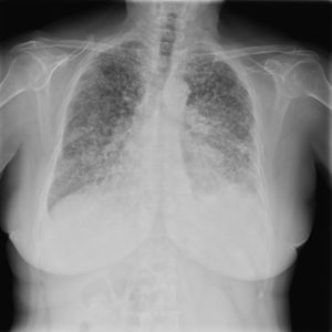 Patrón radiológico micronodular como manifestación de un adenocarcinoma pulmonary.