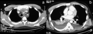 TAC torácico, con vision mediastínica. a) Aumento de densidad mediastínica de forma difusa, mas marcado en mediastino anterior, sugestivo de mediastinitis. b) Derrame pleural bilateral.