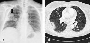 A: radiología simple de tórax (proyección posteroanterior) que muestra un nódulo pulmonar solitario y un área de consolidación en el lóbulo superior derecho (flecha). B: sección axial de tomografía computarizada de tórax en ventana de pulmón, que muestra condensación periférica, con pequeñas áreas de cavitación, rodeada de opacidades en vidrio deslustrado.