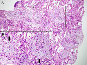 Biopsia transbronquial obtenida mediante fibrobroncoscopia, donde se puede observar parénquima pulmonar peribronquial con proliferación fibroblástica intraalveolar (flechas), indicativo de un patrón histológico de neumonía organizada. A: hematoxilina-eosina (×10 aumentos). B: hematoxilina-eosina (×20 aumentos).