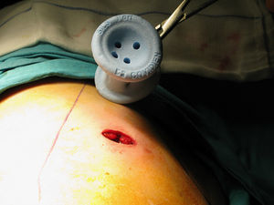 Instrumento SILS ® e incisión cutánea de la técnica.