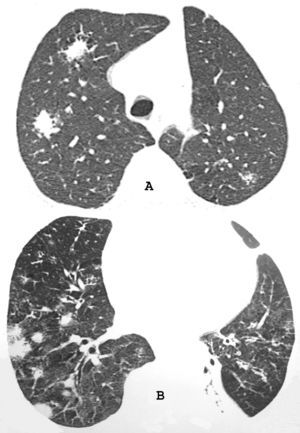 Tomografías computarizadas de los lóbulos superiores (A) e inferiores (B) que muestran nódulos mal definidos de diferentes tamaños, predominantemente en el pulmón derecho, y atelectasia en lóbulo inferior izquierdo.
