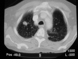TC de tórax: tumoración de contornos especulados en vértice pulmonar derecho sin contacto con la pleura.