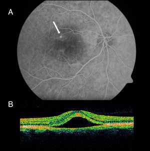 A) Angiografía fluoresceínica donde se aprecia una zona hipofluorescente coincidente con la zona del despegamiento y un punto de fuga hiperfluorescente (flecha blanca) en la fase tardía de llenado arteriovenoso. B) Tomografía de coherencia óptica que demuestra un desprendimiento de la retina neurosensorial con fluido subretiniano.