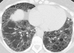 Tomografía computarizada de alta resolución (TCAR) torácica del paciente 1 que muestra un patrón microquístico periférico que predomina en las bases, con imágenes en panal y quísticas así como bronquiectasias por tracción.