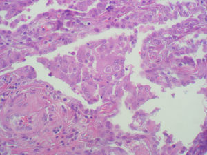 Biopsia pulmonar con presencia de células gigantes multinucleadas intraalveolares con fenómenos de emperipolesis (macrófagos dentro del citoplasma) (tinción de hematoxilina eosina, ×400).