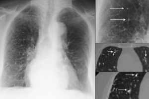 Múltiples opacidades lineales ramificadas en ambos campos pulmonares (derecha arriba, flechas). Derecha, abajo: imagen ampliada de la TC de alta resolución; émbolos de cemento (flechas) en el interior de ramas arteriales pulmonares.
