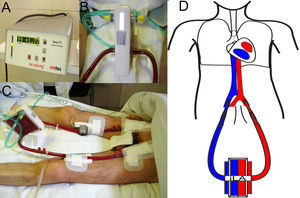 Tratamiento de soporte con iLA AV sin bomba en un paciente con fístula broncopleural e insuficiencia respiratoria grave. Intubación orotraqueal, ventilación mecánica con PEEP de 10cmH2O y volumen corriente 1ml/kg de peso ideal. A) Membrana de intercambio y canulaciones arterial y venosa. B) Detalle del iLA conectado a las líneas arterial y venosa y a la toma de oxígeno. C) Medición del flujo a través del sistema, en este caso 1,77 litros de sangre por minuto. D) Esquema de canulación AV para tratamiento con sistema interventional lung assist (iLA).