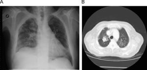 A. Radiografia de tórax: nódulo paratraqueal derecho. B. TAC torácica: detalle de nódulo paratraqueal derecho.