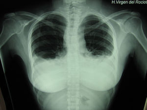 En la radiografía simple de tórax se evidencia derrame pleural bilateral tras realización de la cirugía.